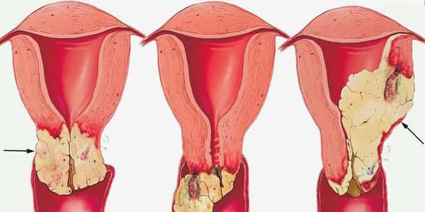 أعراض سرطان عنق الرحم بالتفصيل